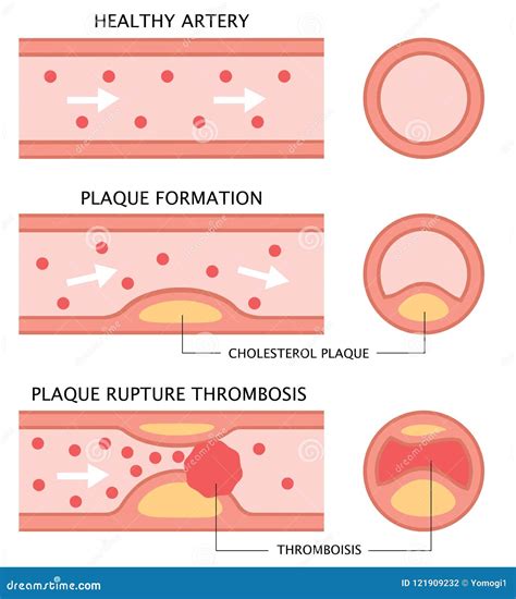 Atherosclerosis Stages Healthy Artery Plaque Formation And