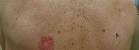 Skin Cancer Skin Cancer On Back