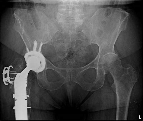 Revision Hip Replacement For Treatment Of Chronic Infection And