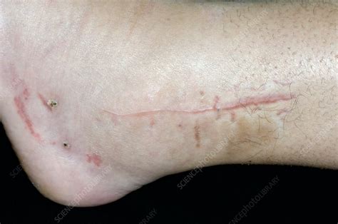 Scar On Ankle After Internal Pinning Stock Image C0041287