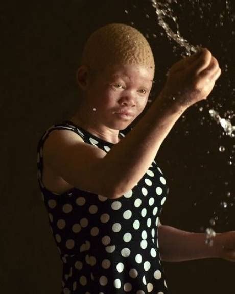 Menschen Mit Albinismus In Afrika Noch Immer Diskriminiert Pilatustoday