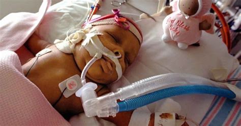 Ecmo Life Support Treatment For Baby Child And Adult