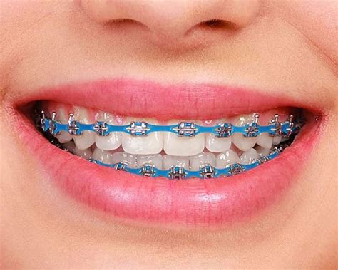 Braces And Power Chains Gibbs Orthodontic Associates