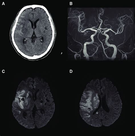 Ct Image Of The Brain 1 Day After The Mechanical Thrombectomy Showing