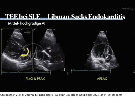 Abbildung Libman Sacks Endokarditis