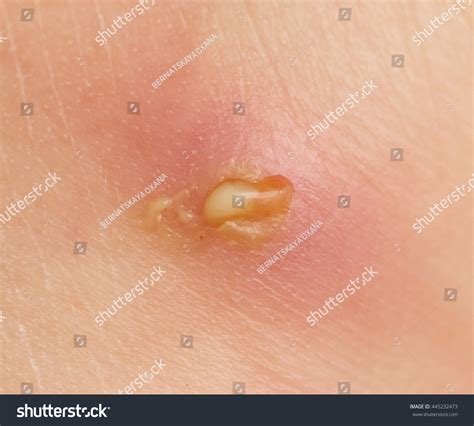 Boil On The Skin Stock Photo 445232473 Shutterstock