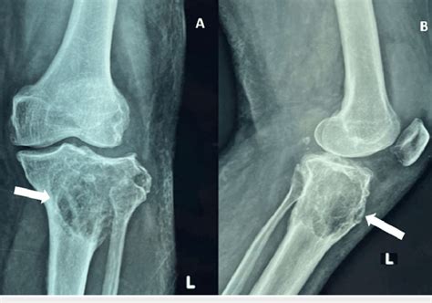 Anteroposterior Ap And Lateral View X Rays Of The Left Knee Showing