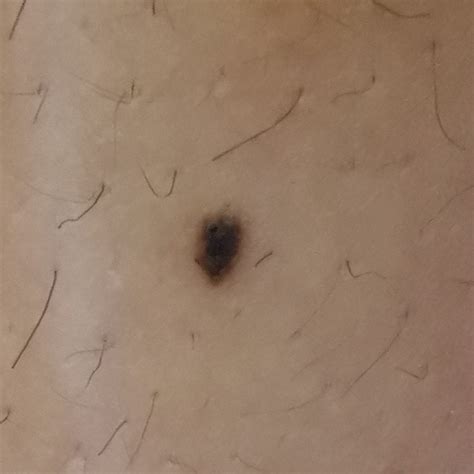 Should I Get This Checked Out Doesnt Itch Or Hurt Rmelanoma