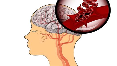Causas síntomas y tratamiento para controlar una hemorragia cerebral