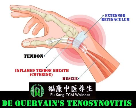 Understanding What Is Actually De Quervains Tenosynovitis Its Causes
