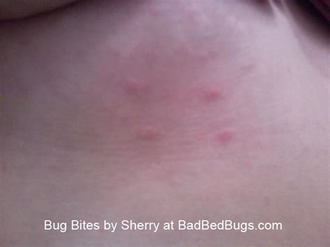 Bedbug Bites Discussion Pg 3