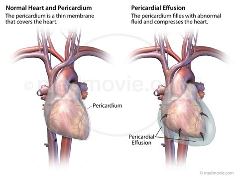 Pericardial Effusion Medmovie Com