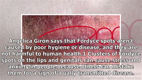 Fordyce Spots Causes Symptoms And Treatments Youtube