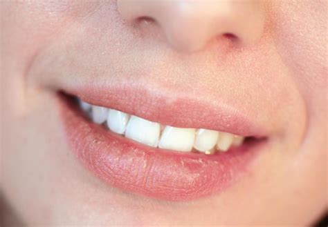 What Causes Chapped Lips With Pictures