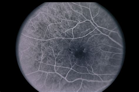 Myopic Degeneration Retina Image Bank