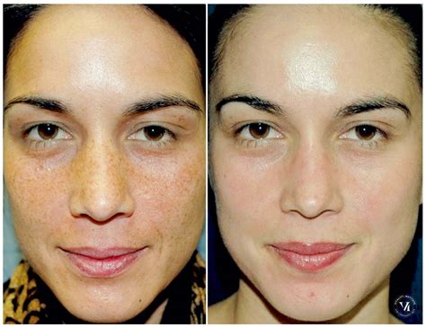 Chemical Peels Swan Center For Plastic Surgery