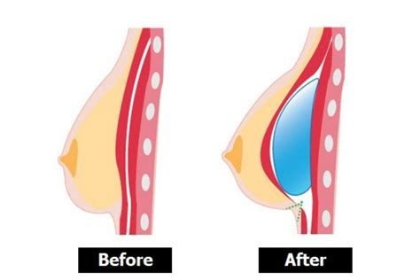 Dec 17, 2019 · fenugreek tea for breast enlargement clean and wash the fenugreek seeds. How to Use Fenugreek Seeds (Methi Seeds) for Breast ...