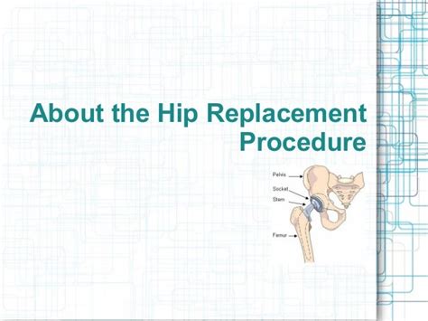 About The Hip Replacement Procedure