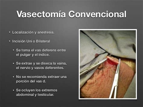 Vasectomía Y Circuncision