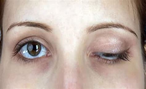 The most commonly affected muscles are those of the eyes, face, and swallowing. La miastenia gravis aparece cada año en 700 nuevos casos
