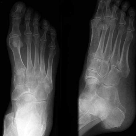 Navicular stress fracture | Image | Radiopaedia.org