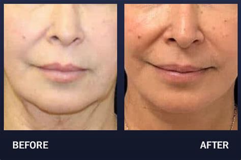 Buccal Fat Removal Before And After Pictures Madnani Facial Plastic Surgery