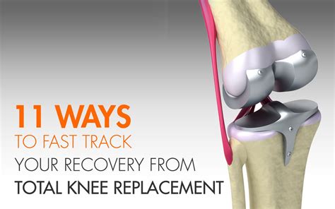 Knee Replacement Recovery Recovery Time Knee Replacement