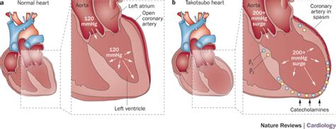 sindrome tako tsubo cause sintomi e trattamento