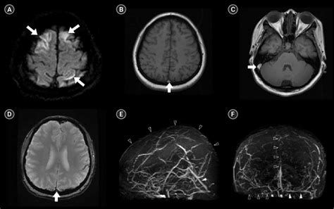 Cerebral Venous Thrombosis A Diffusion Weighted Magnetic Resonance