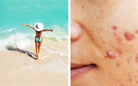 Acne Treatment How To Get Rid Of Summer Acne The Healthy