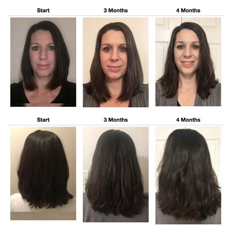 Our hair loss success stories gallery shows a wade variety of results. Volumique Solutions Step-1; Cleanse Shampoo; Hair Growth ...