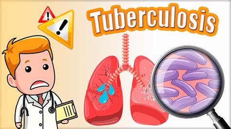 🔴🔴 Tuberculosis Tb Síntomas Diagnóstico Mantoux Y Tratamiento