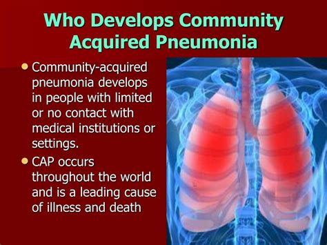 Ppt Community Acquired Pneumonias Powerpoint Presentation Free