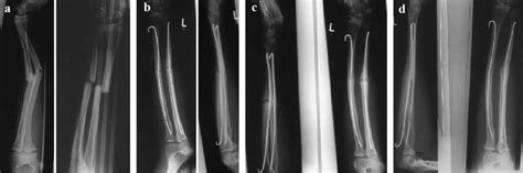 Conservative Treatment Of Nonunion Of A Mid Shaft Fracture After