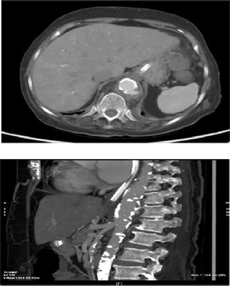 Ct Of The Abdomen And Pelvis With Contrast At The Time Of Presentation