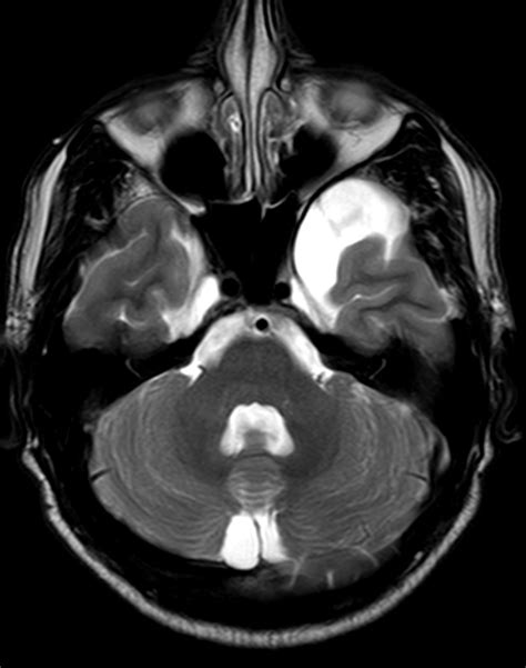 Arachnoid Cyst Middle Cranial Fossa Image
