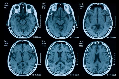 Brain Mri And Eeg Clues To Covid Related Encephalopathy