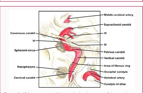 Figure From Surgical Approaches To The Internal Carotid Artery At The
