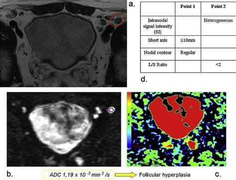 An Example Of Benign Lymph Node A T2w Image B Dw Image C Adc