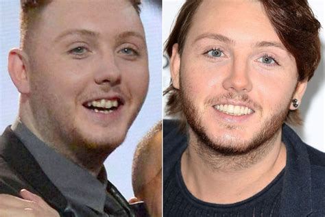 celebrities who had braces before and after before and after
