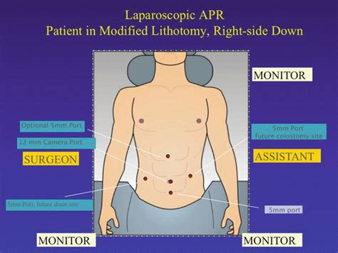 Laparoscopic Abdominoperineal Resection Abdominal Key