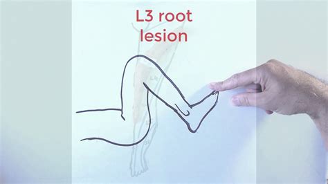 L3 Nerve Root Lesion Youtube