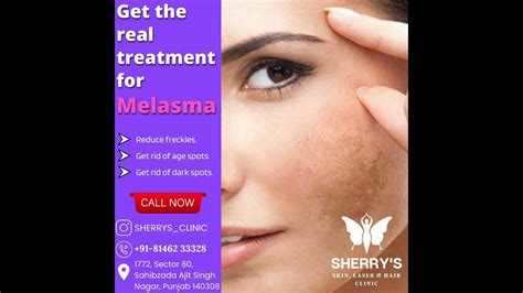Best Specialist For Melasma Skin Specialist Sherrys Skin Laser And Hair Clinic Mohali Youtube