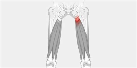 High Hamstring Tendinopathy A Persistent Pain In The Butt Ni Running