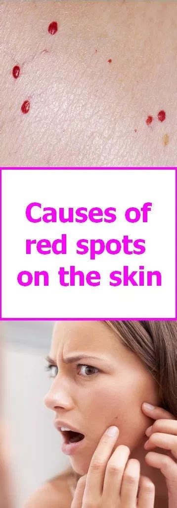 Causes Of Red Spots On The Skin Varicoseveinsremedy Prodotti Per La