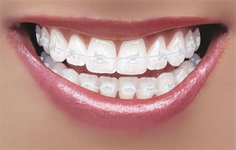 Best Dental Braces In Bangalore Lingual Braces Cost India