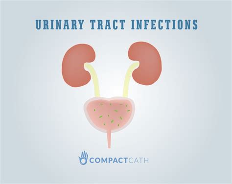 Sex With Uti Yes Or No Compactcath