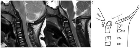 Craniovertebral Junction Early Changes In Patients With Achondroplasia