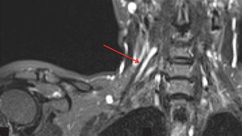 Imaging In Peripheral Neuropathy Ultrasound And Mri Indian Journal