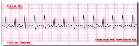 ECG Educator Blog Sinus Tachycardia